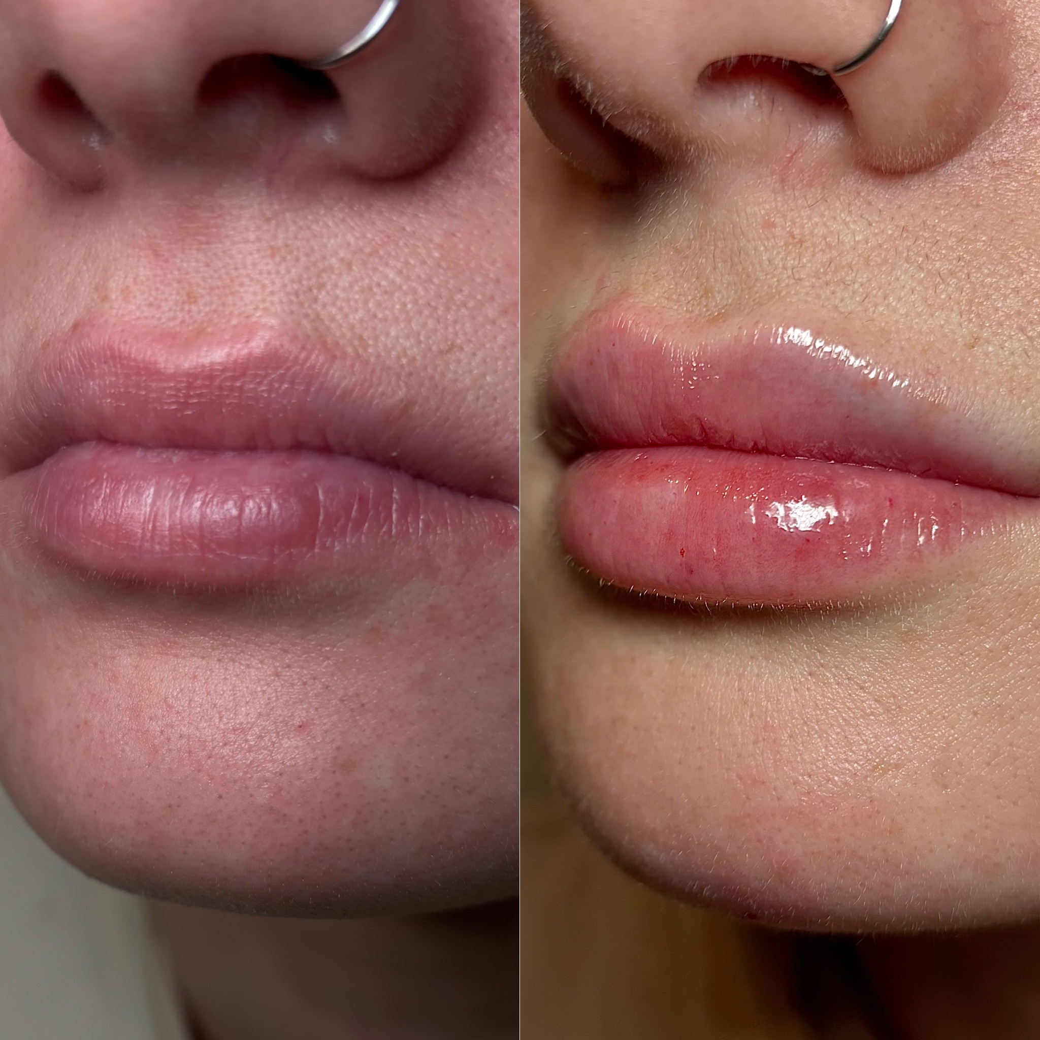 Before and After Image: Dermal Filler - left-front-oblique