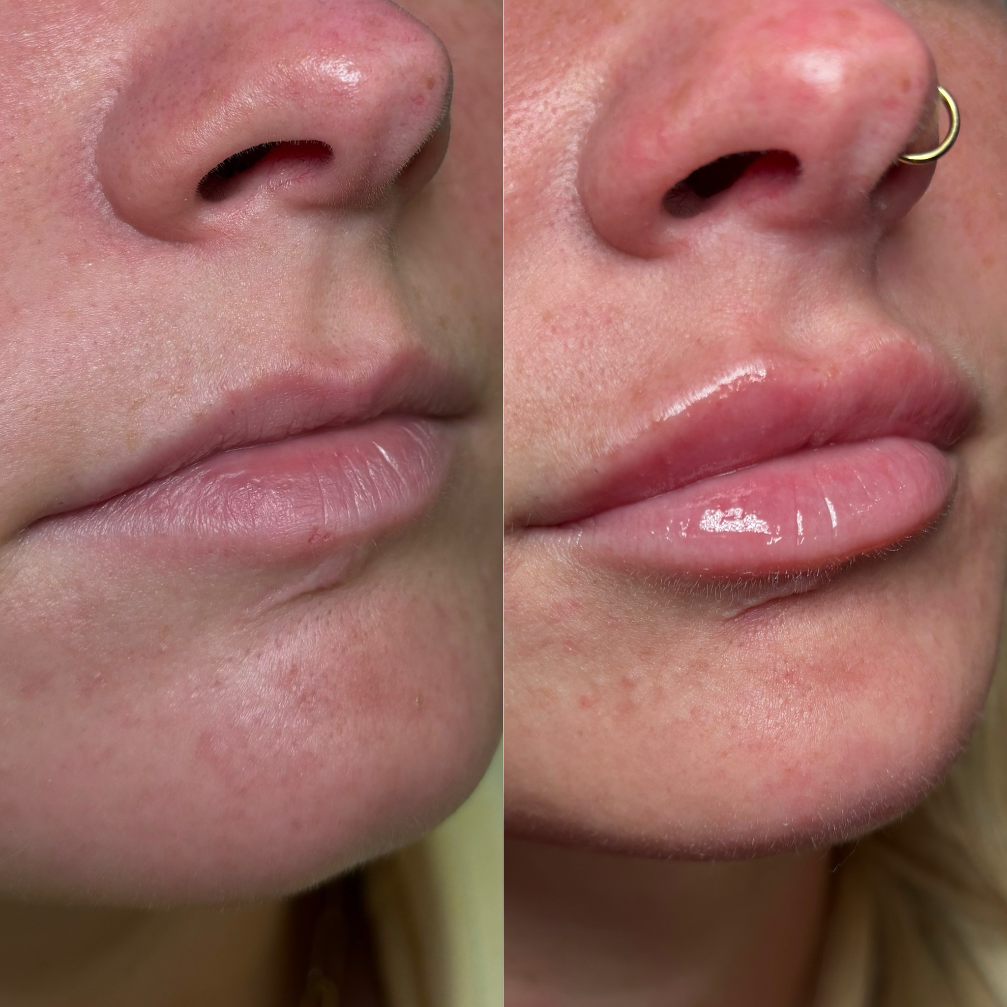 Before and After Image: Dermal Filler - right-front-oblique