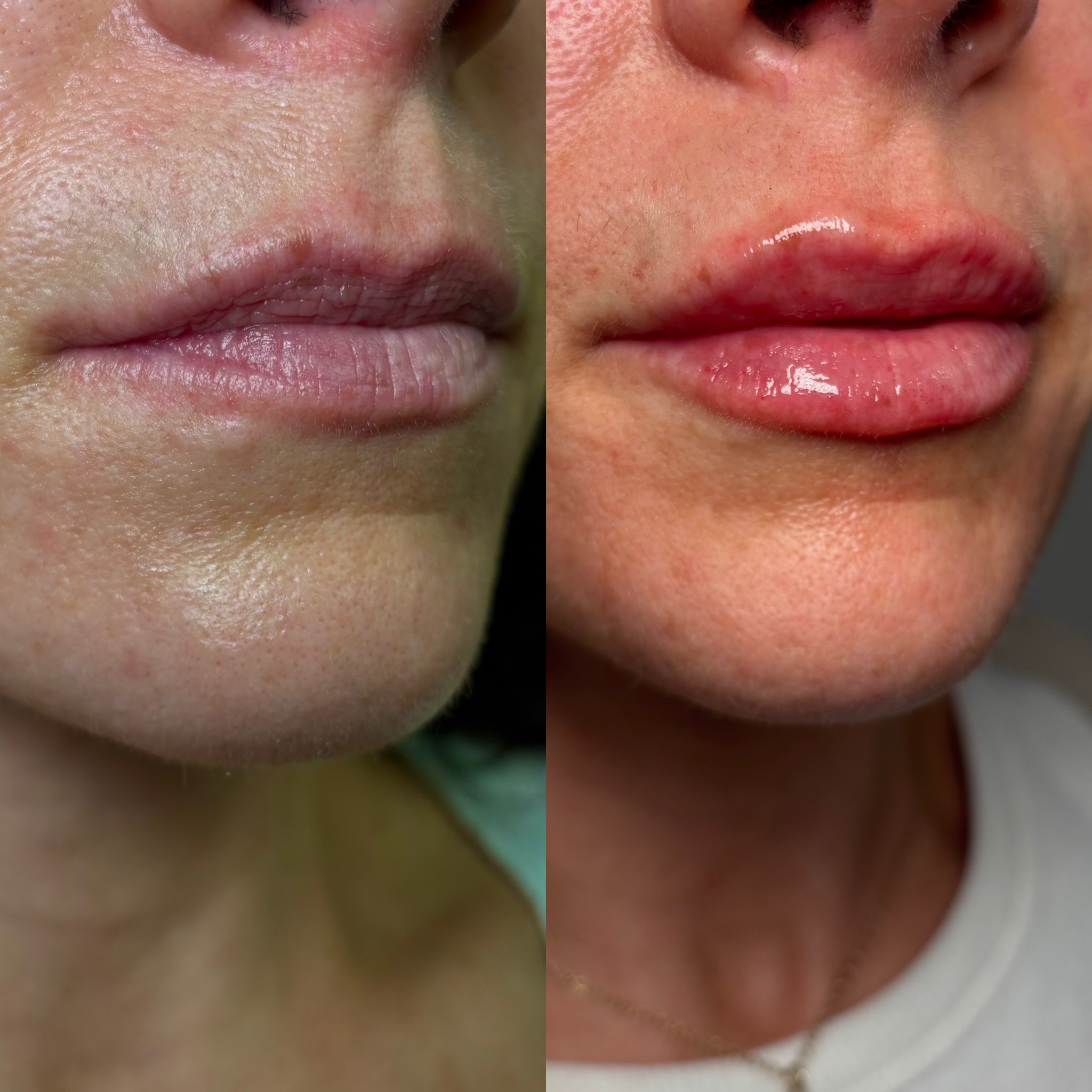 Before and After Image: Dermal Filler - right-front-oblique