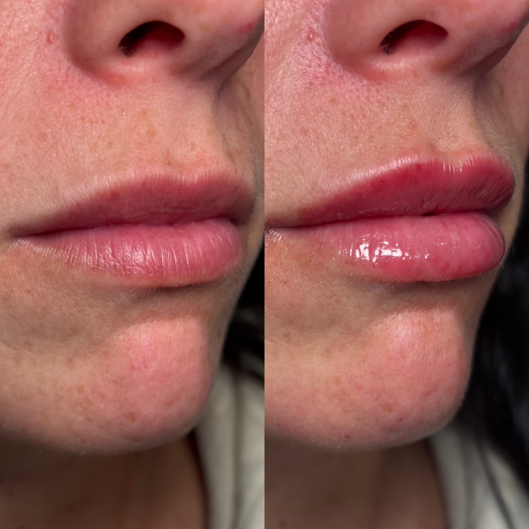Before and After Image: Dermal Filler - right-front-oblique
