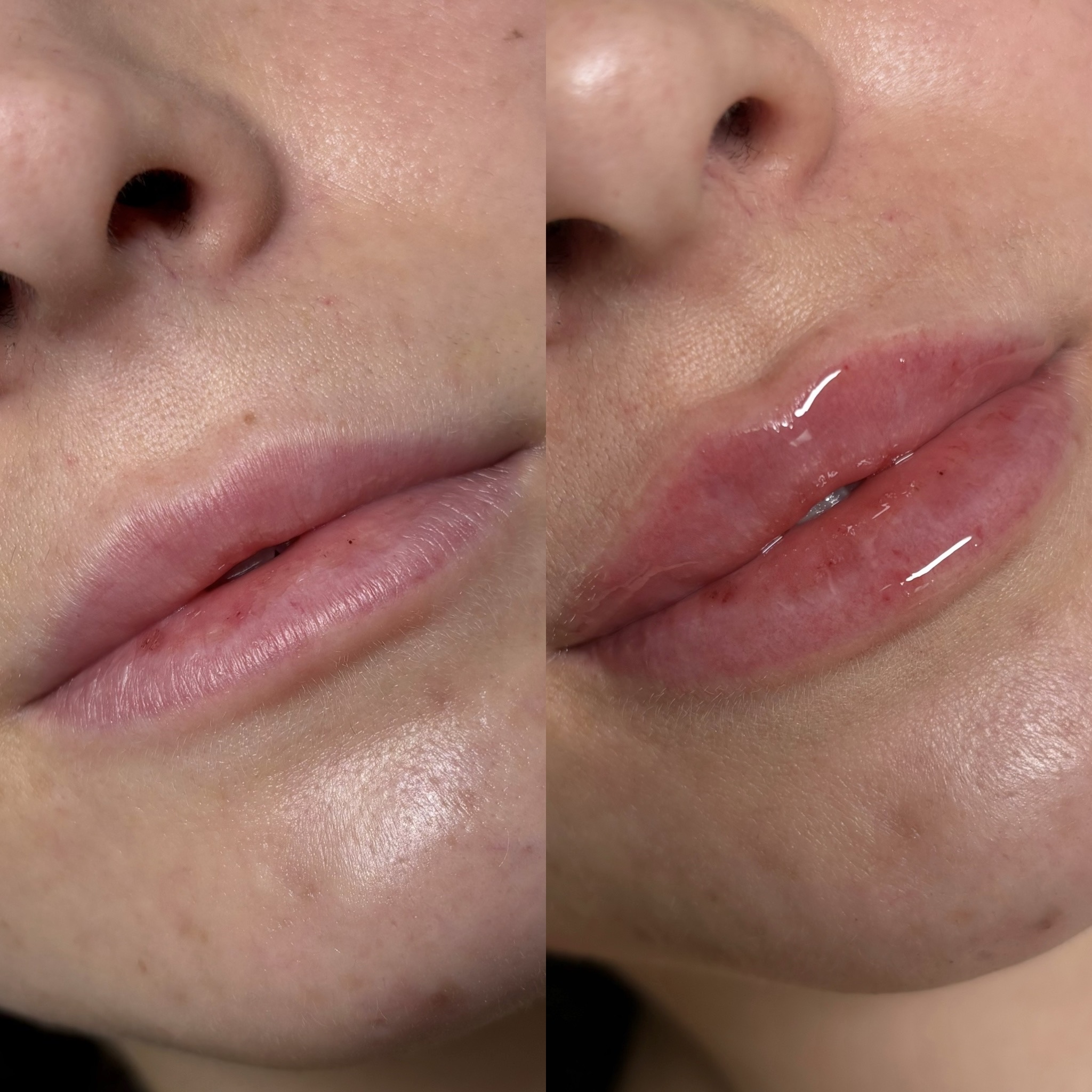 Before and After Image: Dermal Filler - right-front-oblique