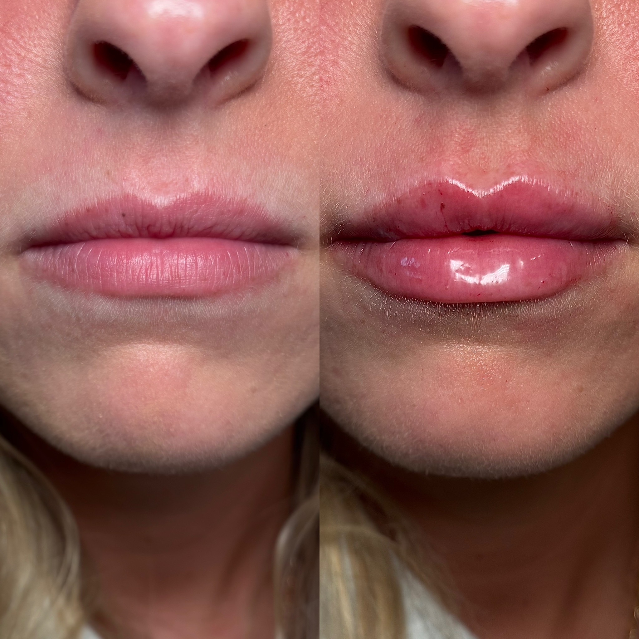 Before and After Image: Dermal Filler - front