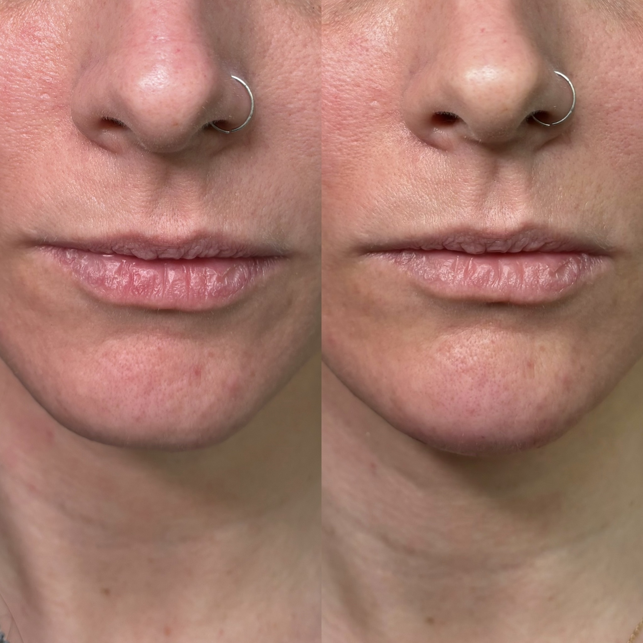 Before and After Image: Dermal Filler - front