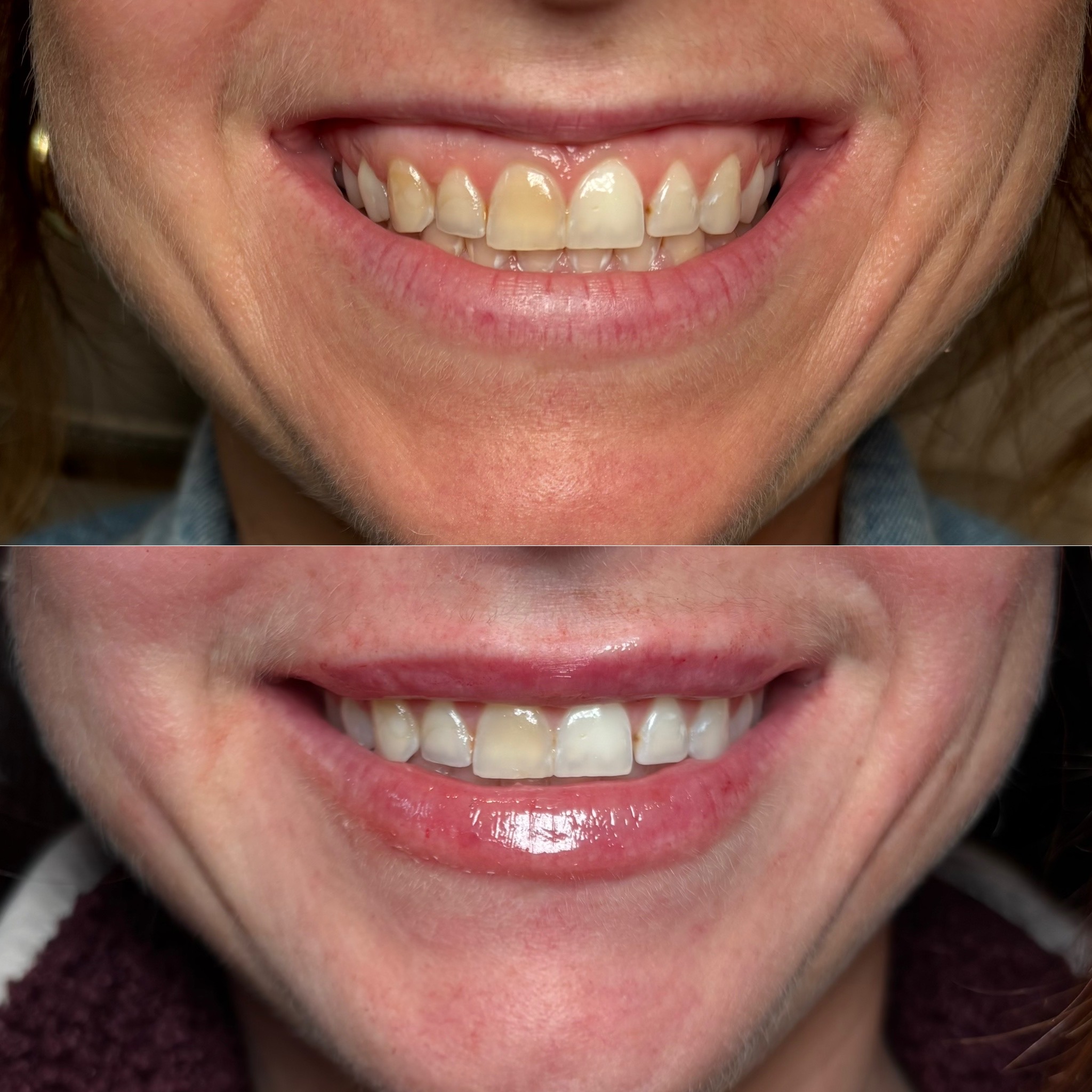 Before and After Image: Dermal Filler - front