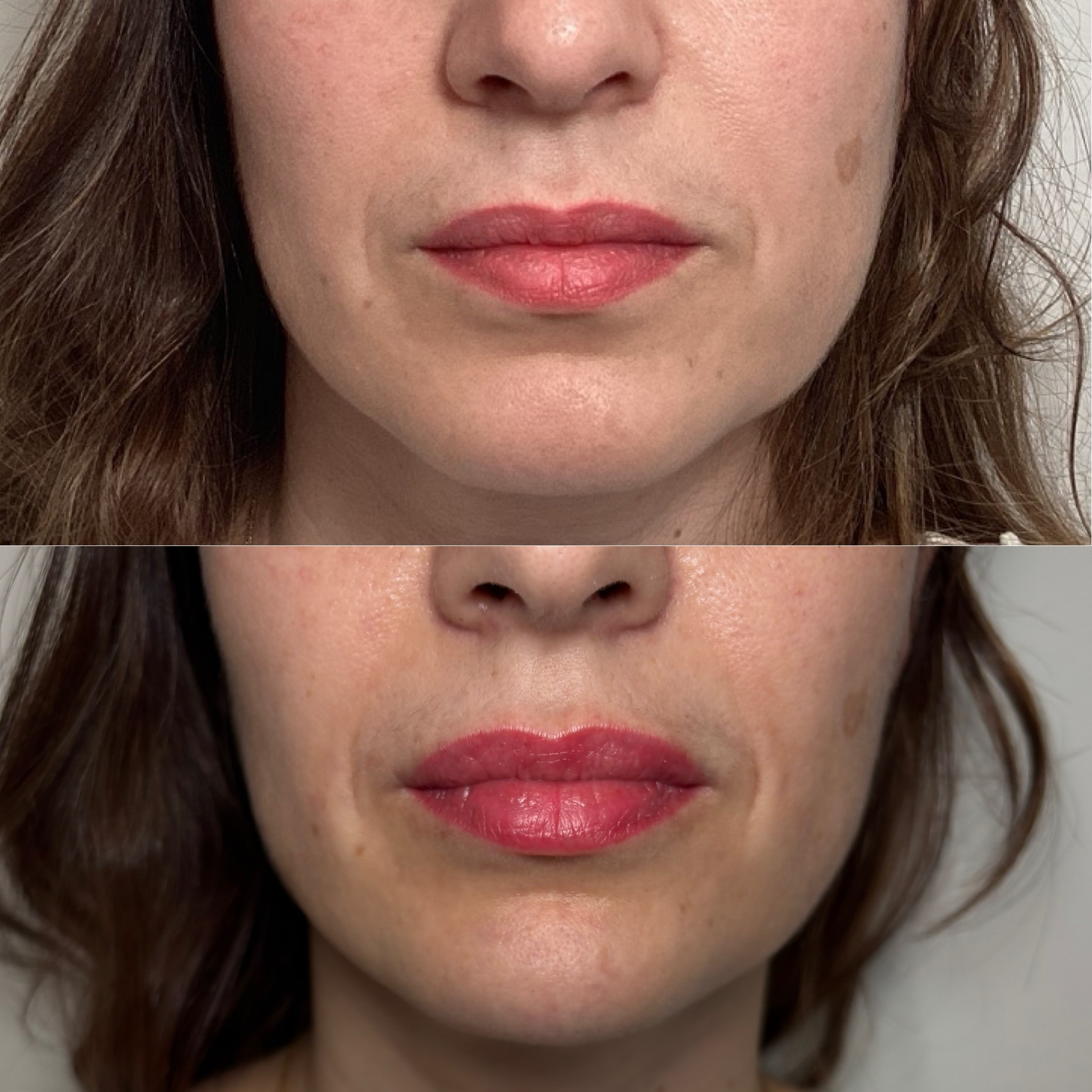 Before and After Image: Dermal Filler - front
