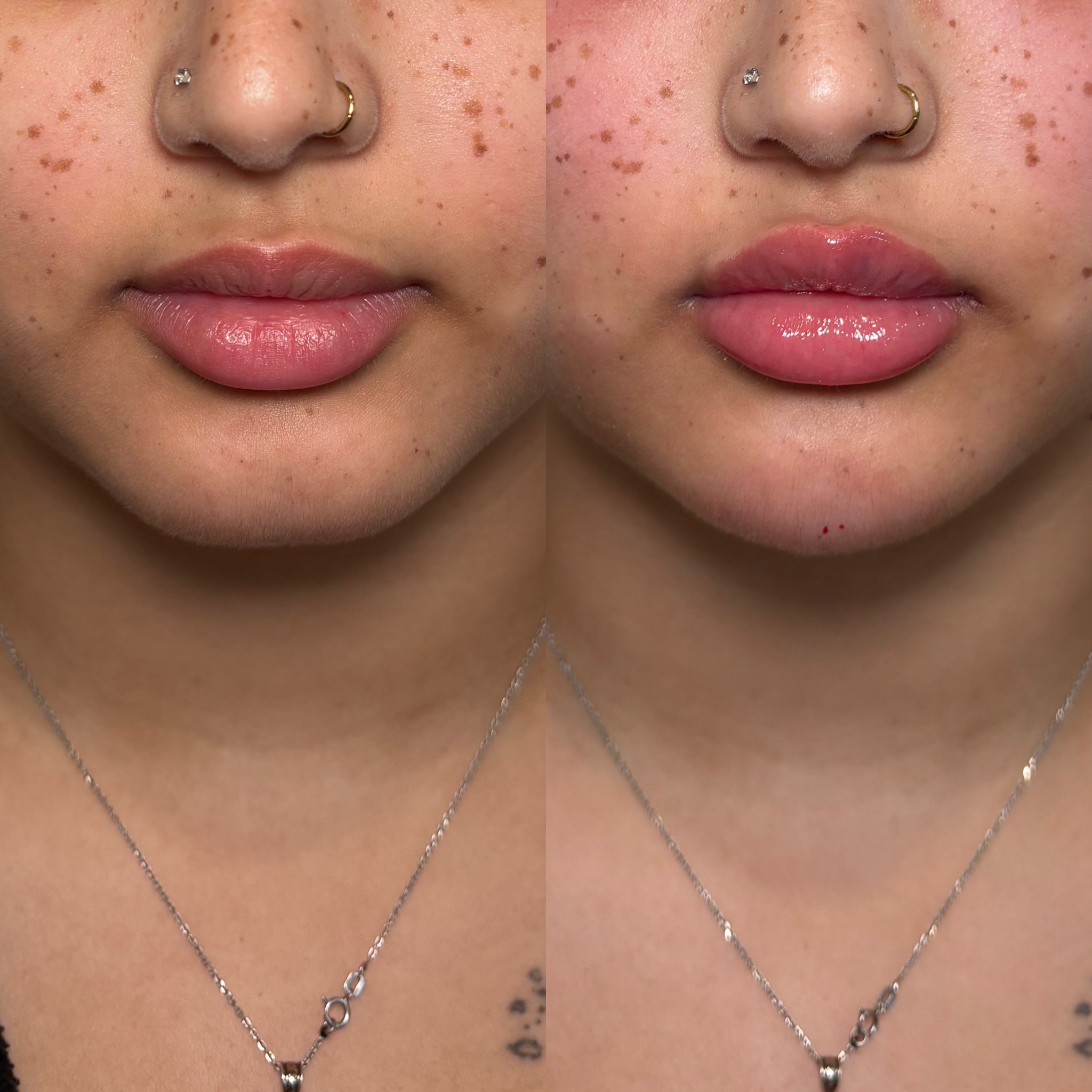 Before and After Image: Dermal Filler - front