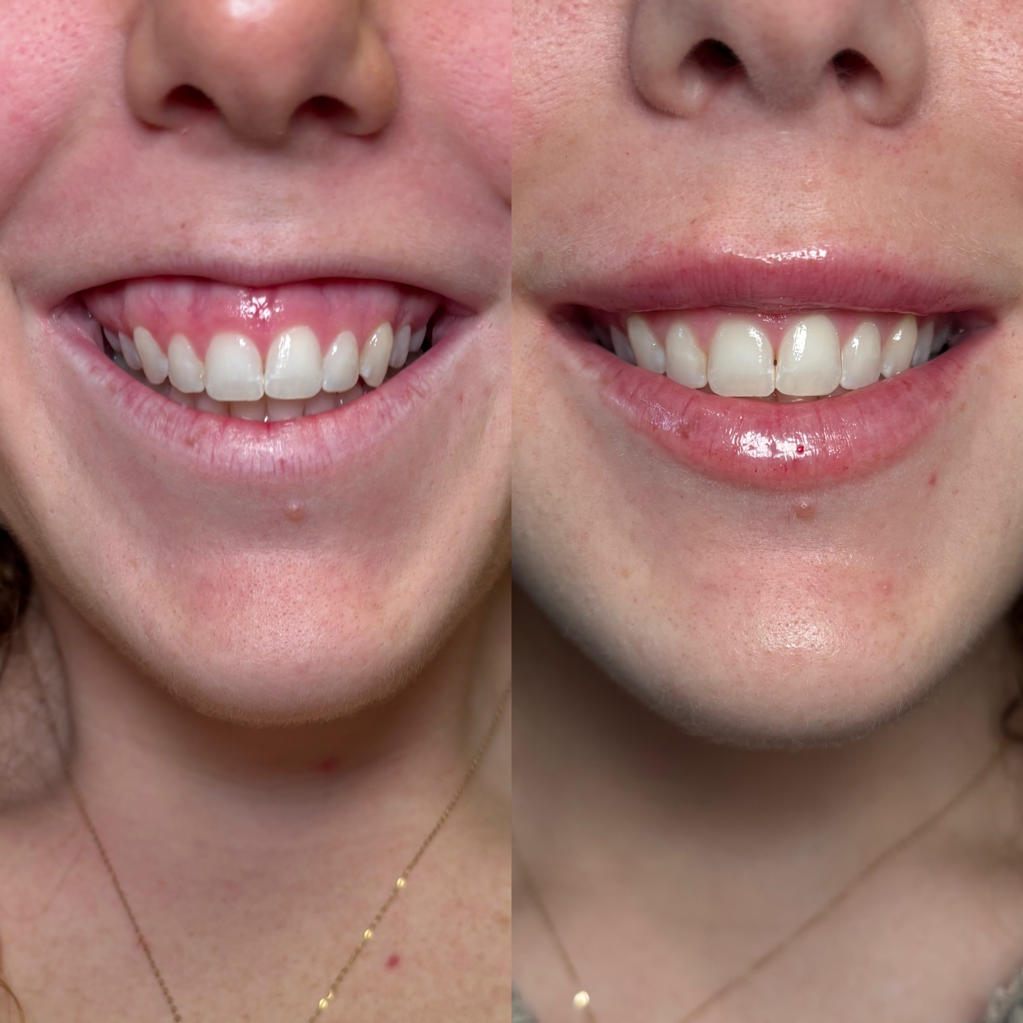 Before and After Image: Dermal Filler - front