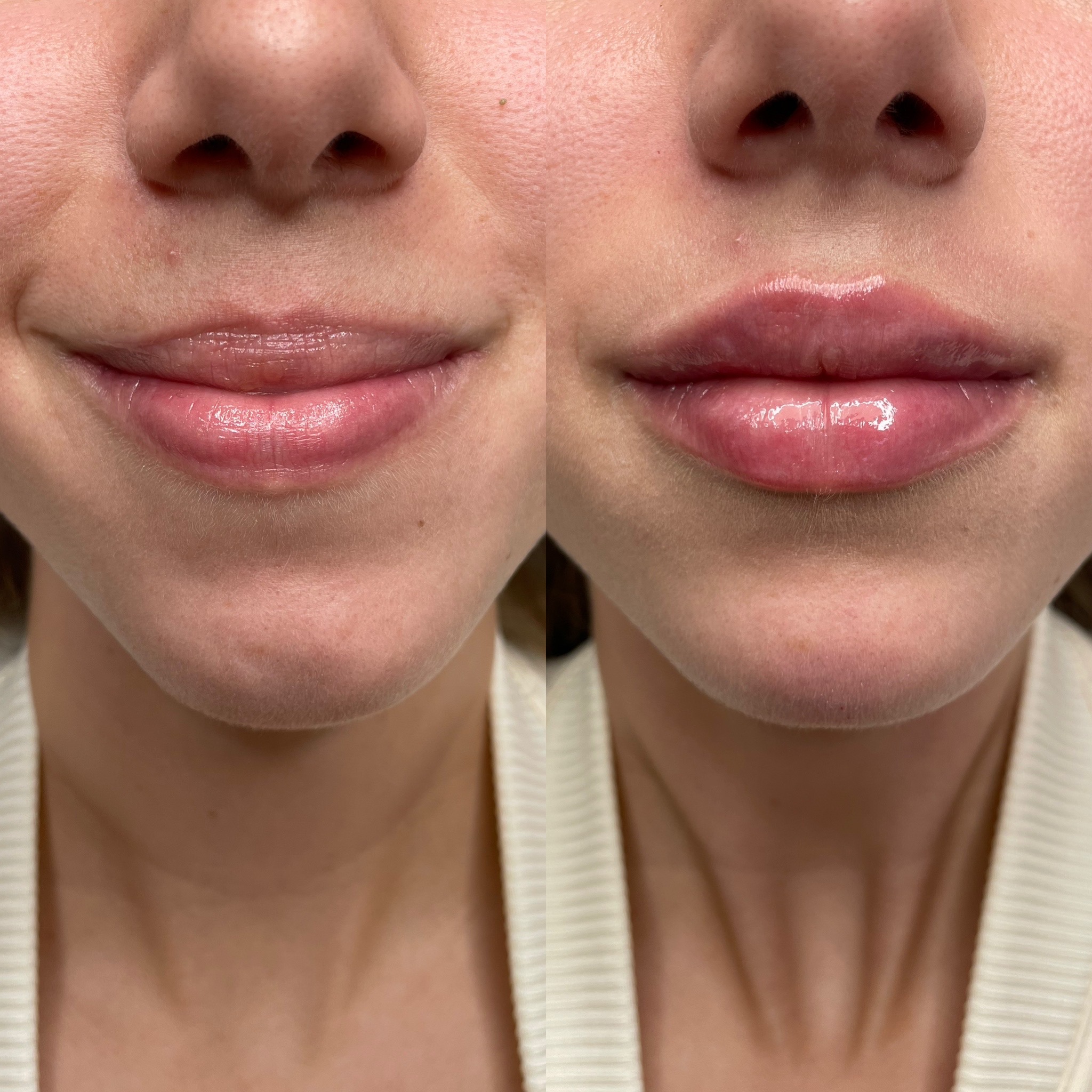Before and After Image: Dermal Filler - front