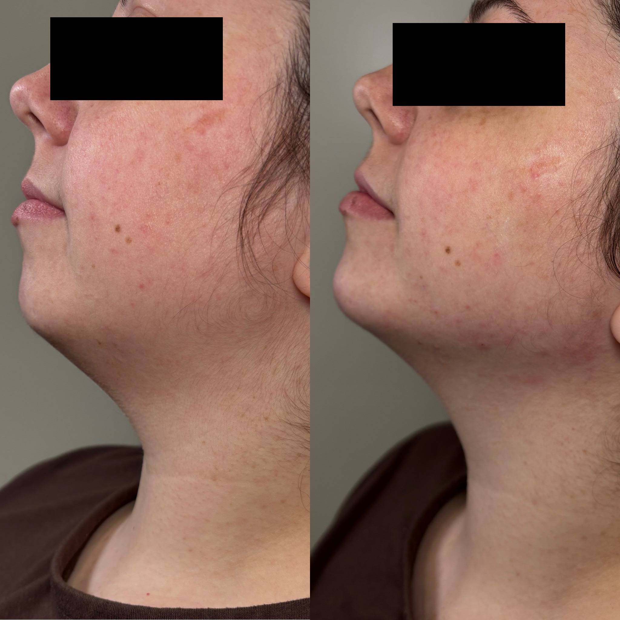 Before and After Image: Dermal Filler - left-side