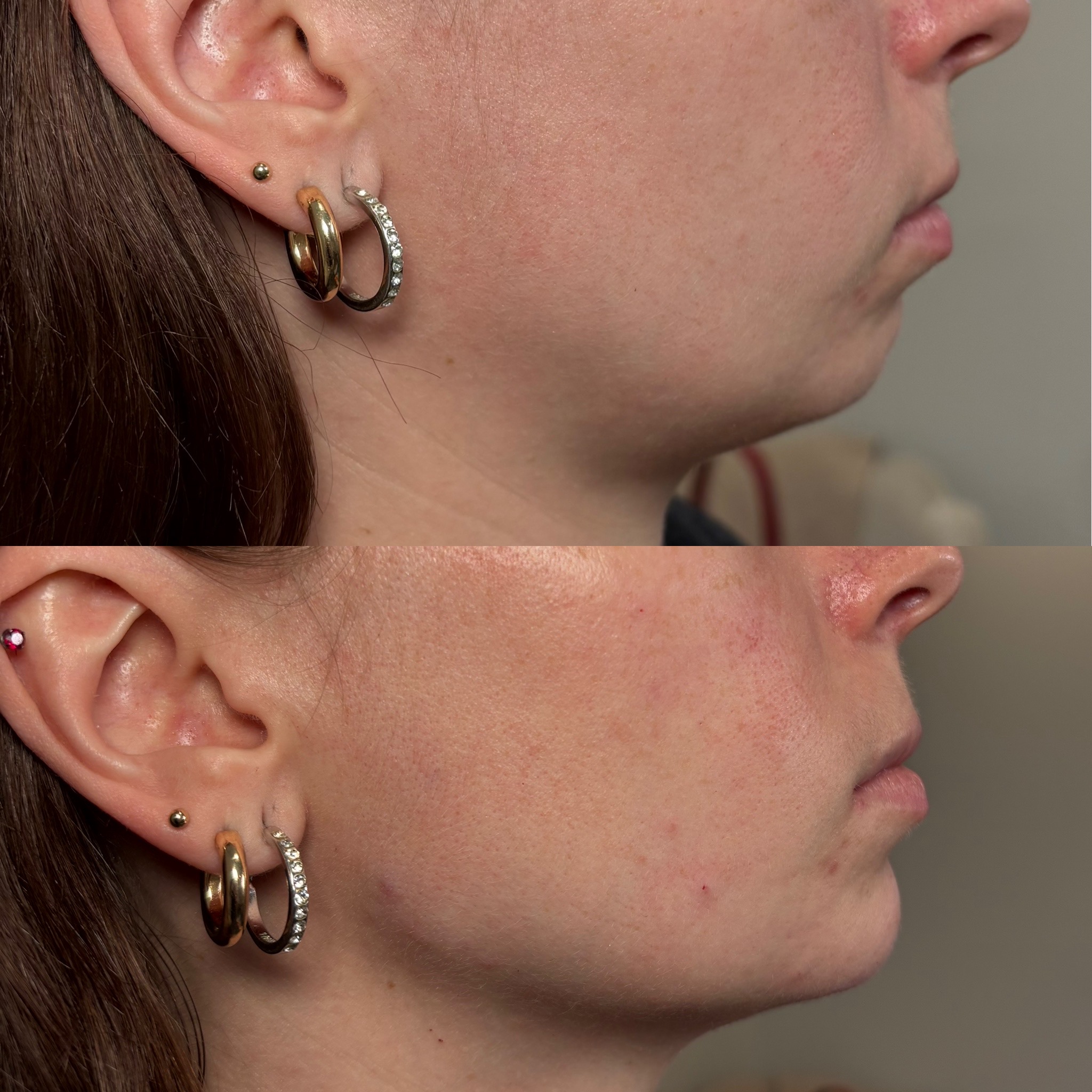 Before and After Image: Dermal Filler - right-side