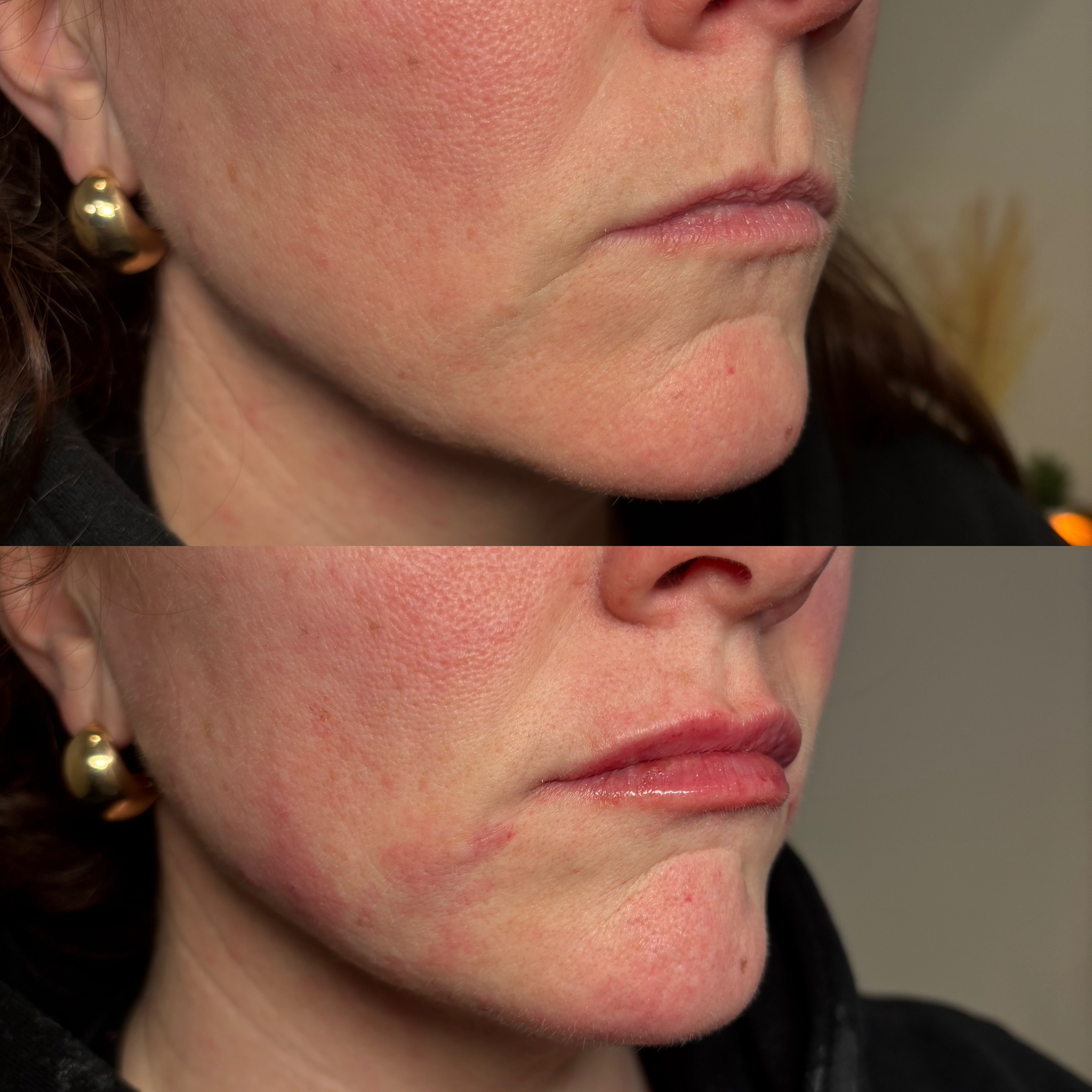 Before and After Image: Dermal Filler - right-front-oblique