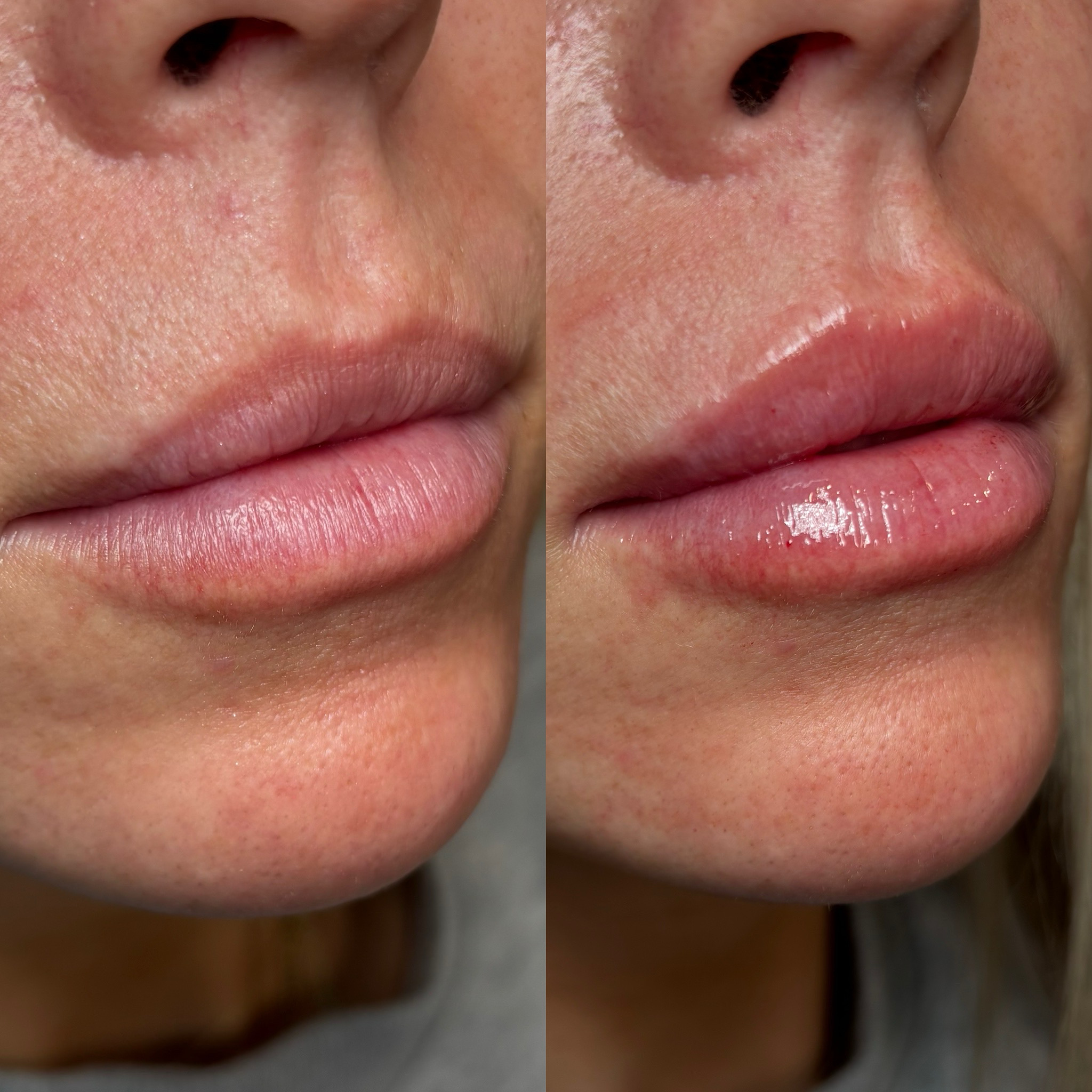 Before and After Image: Dermal Filler - right-front-oblique