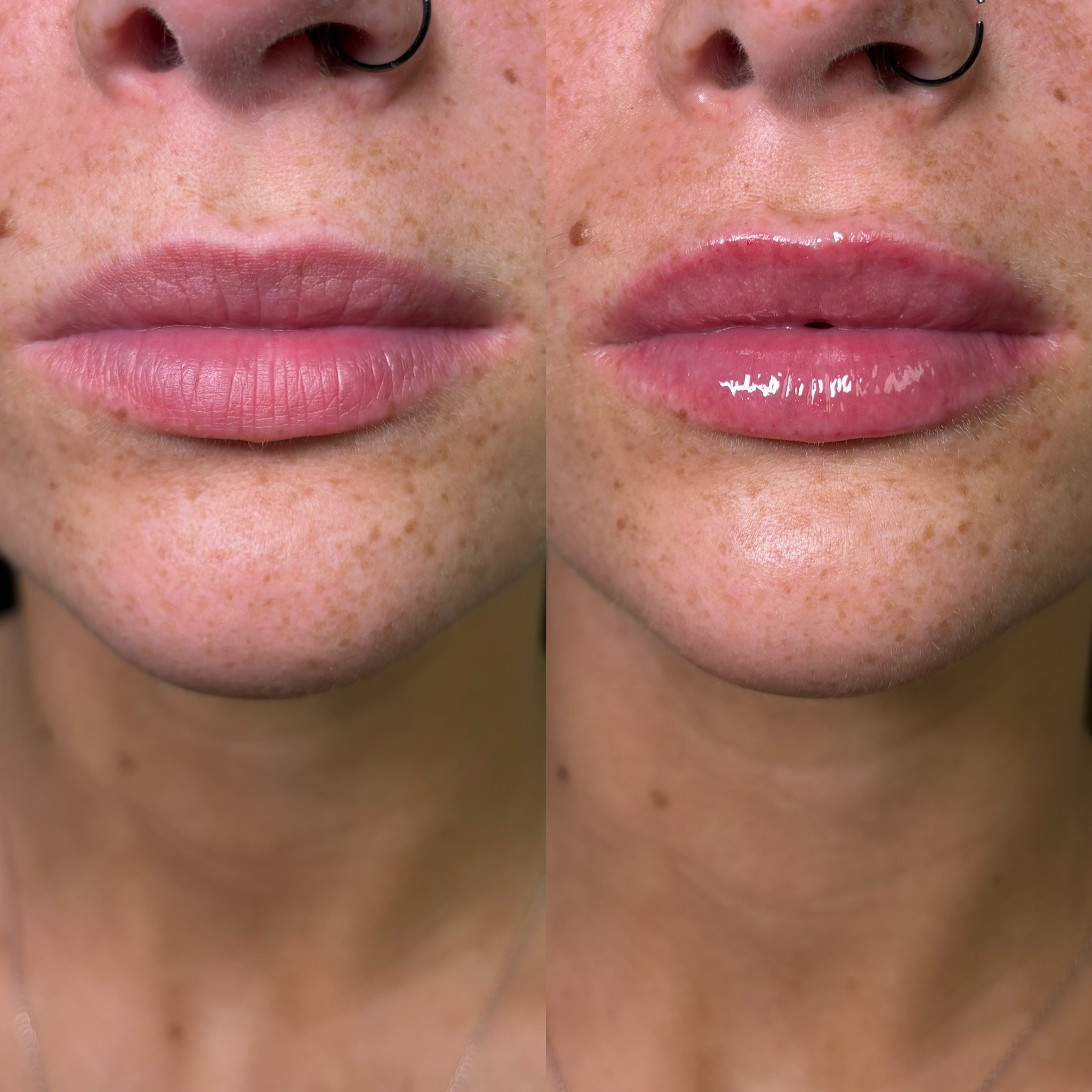 Before and After Image: Dermal Filler - front
