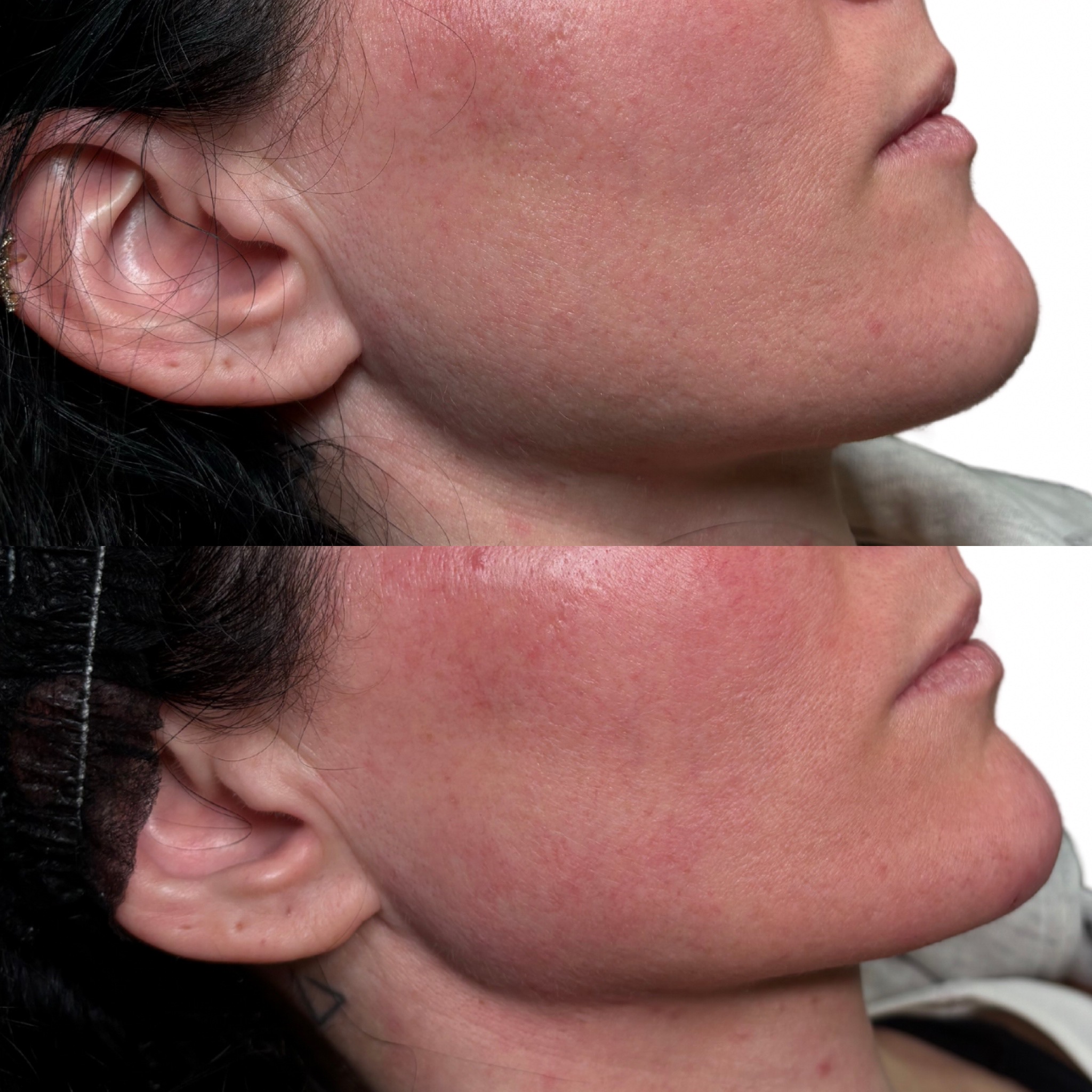 Before and After Image: Dermal Filler - right-side