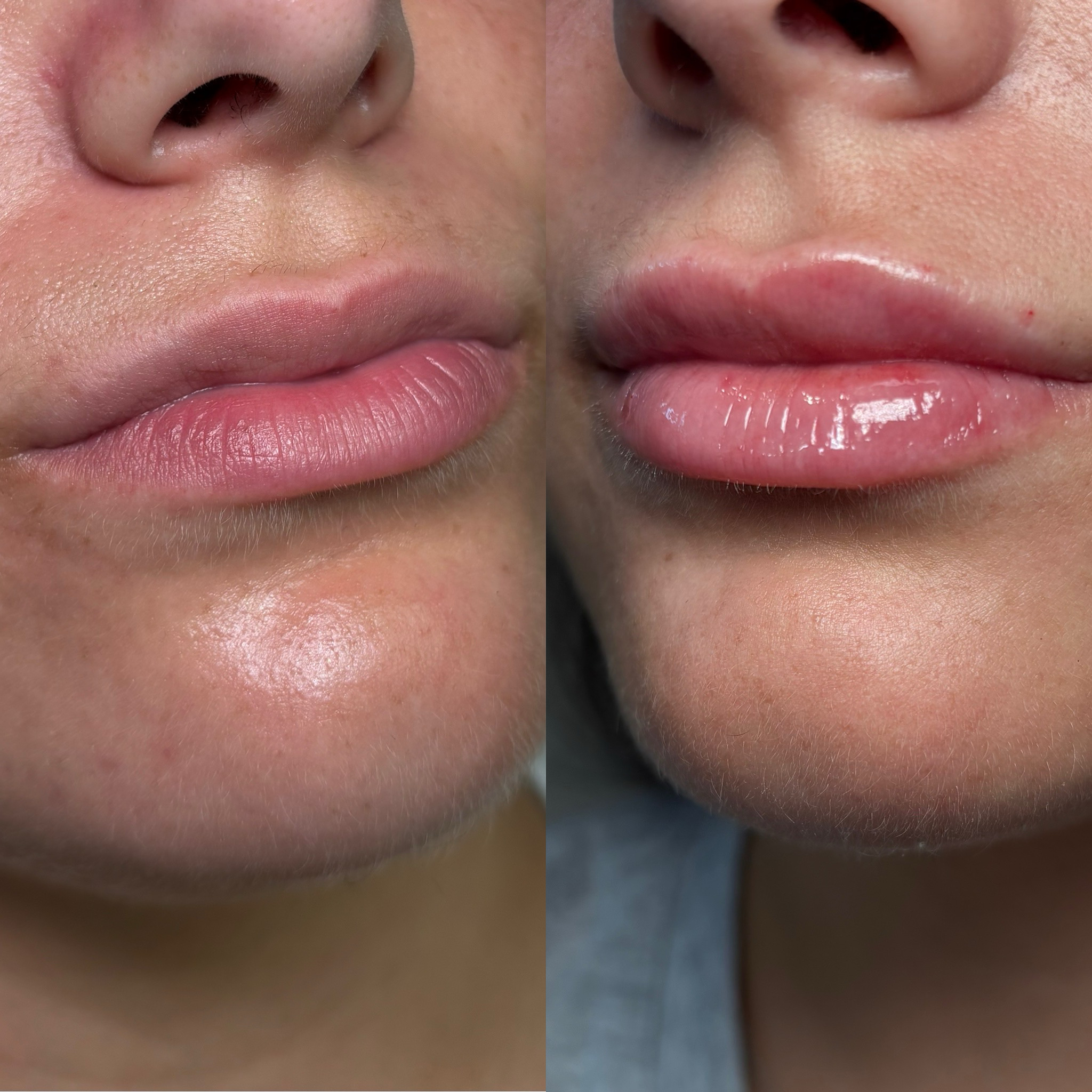 Before and After Image: Dermal Filler - other