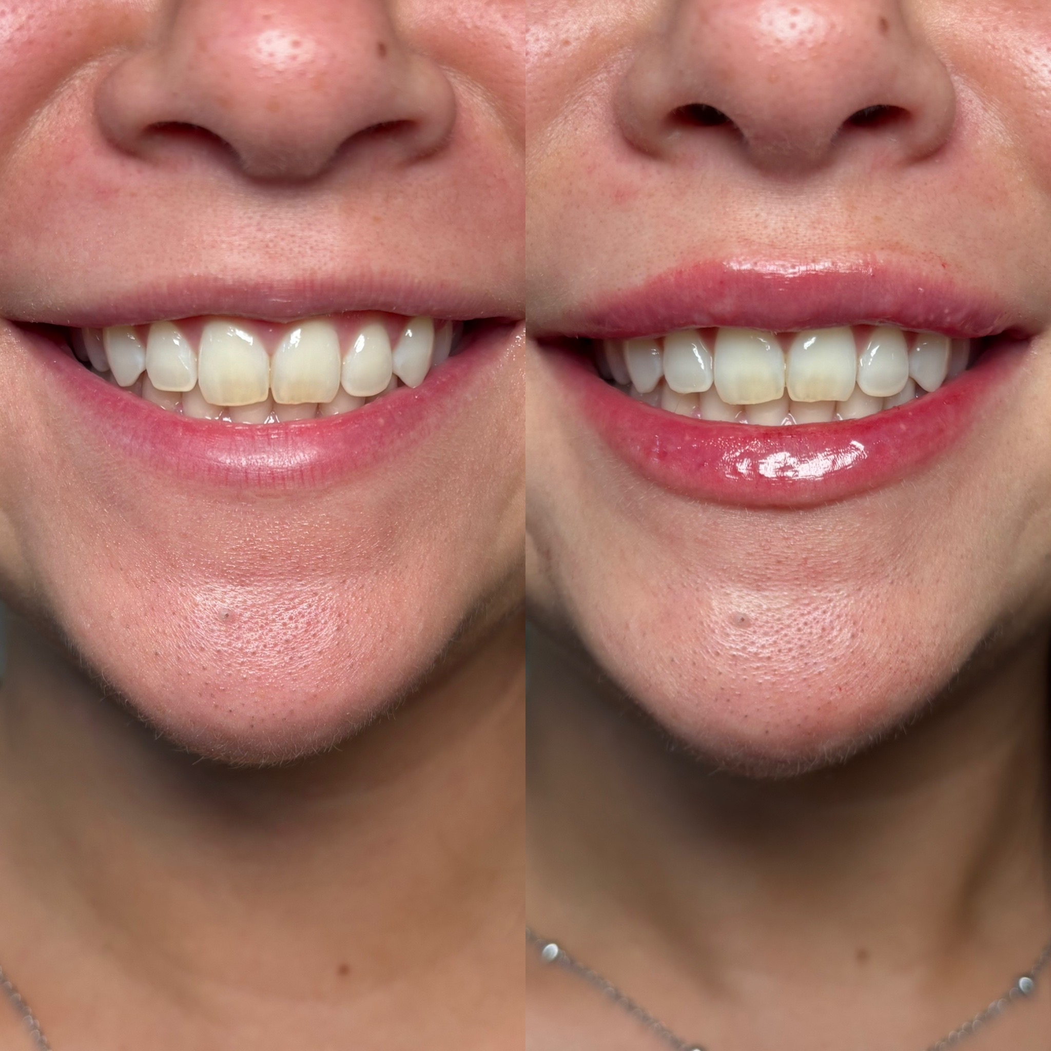 Before and After Image: Dermal Filler - front
