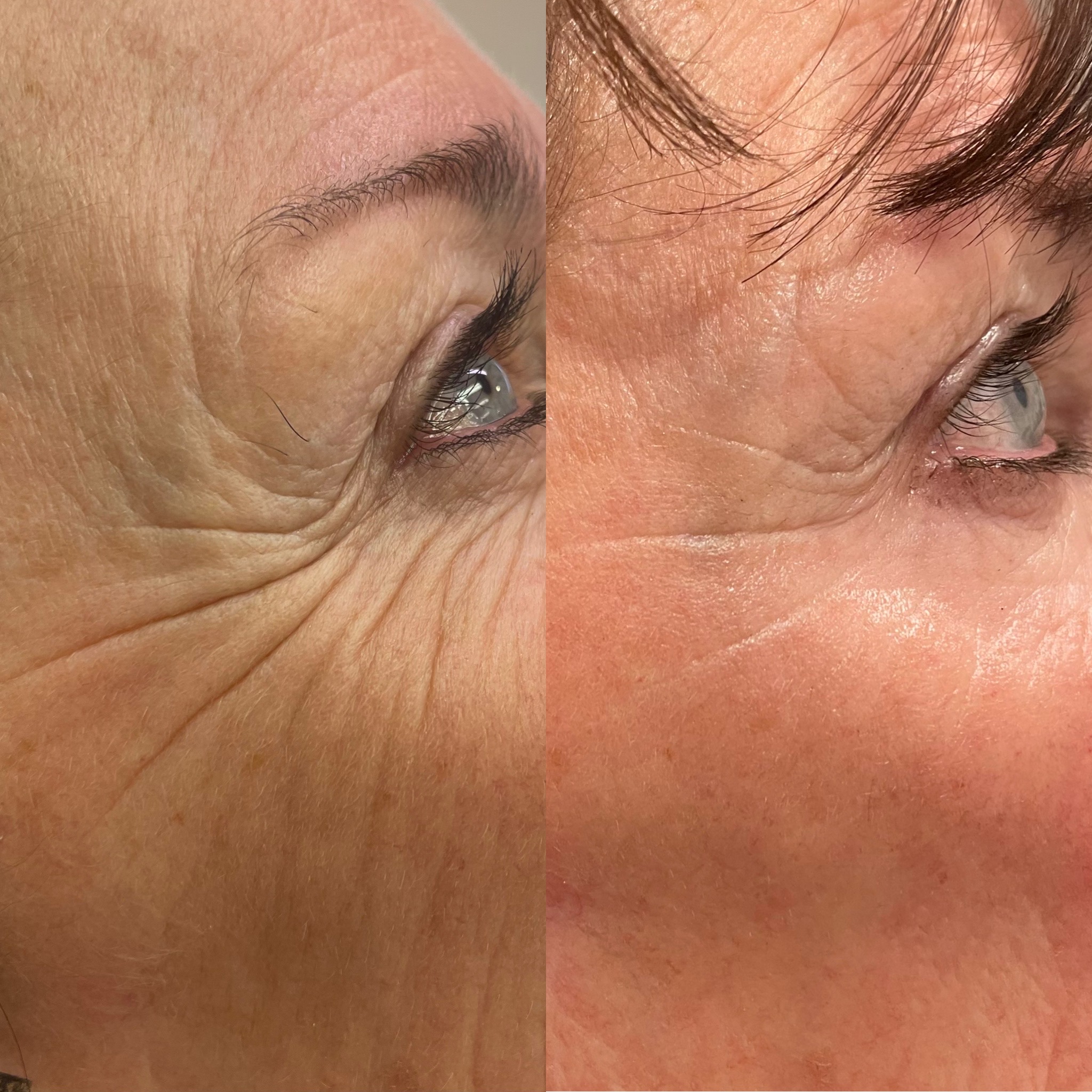 Before and After Image: Dysport (Neurotoxin) - right-side