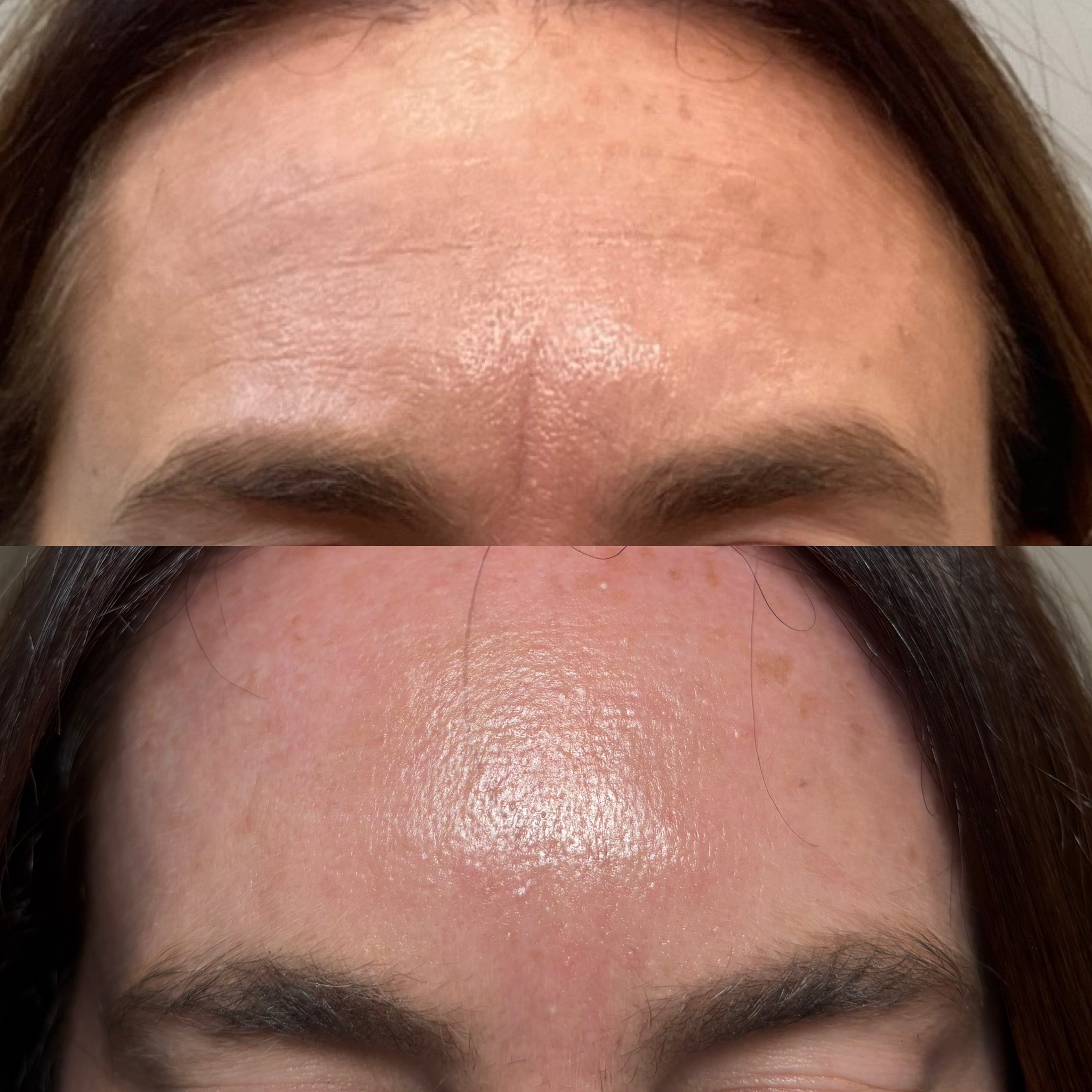 Before and After Image: Dysport (Neurotoxin) - front