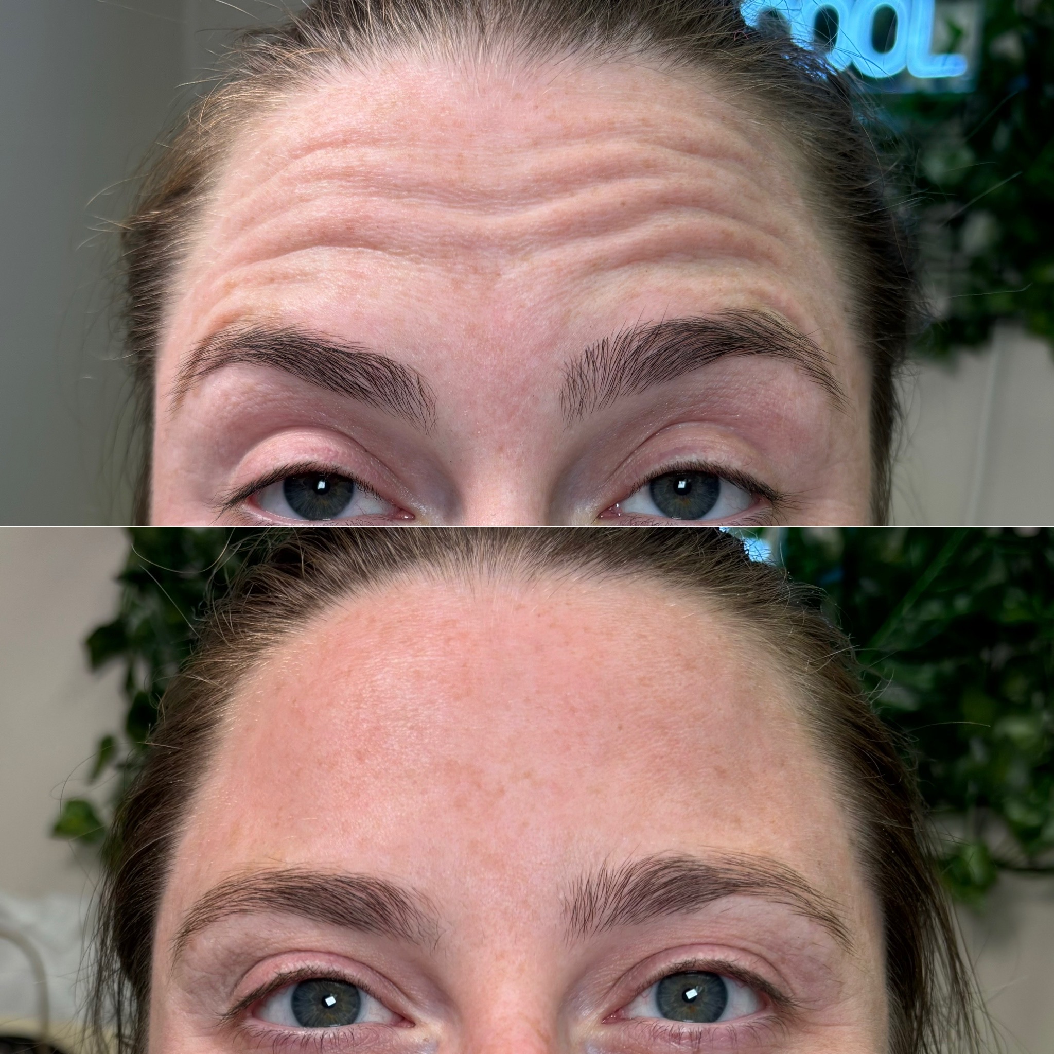 Before and After Image: Dysport (Neurotoxin) - front