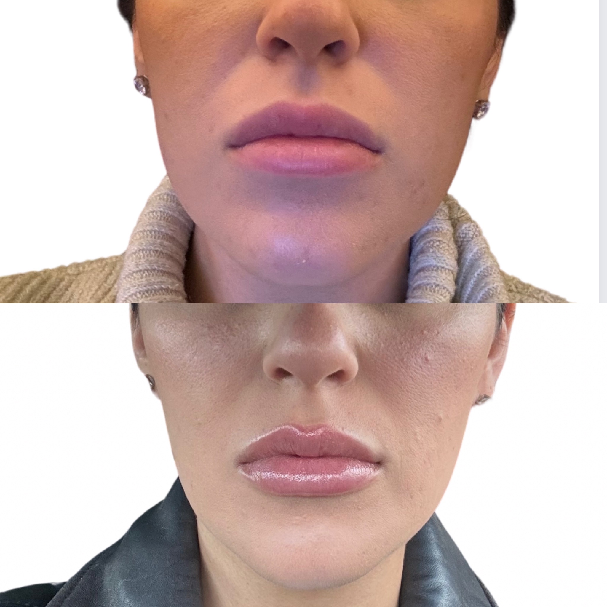 Before and After Image: Dysport (Neurotoxin) - front