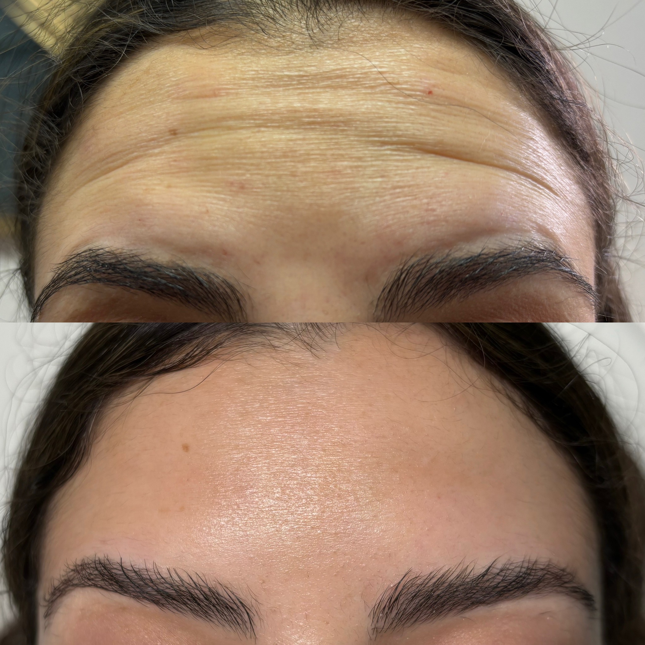 Before and After Image: Dysport (Neurotoxin) - front