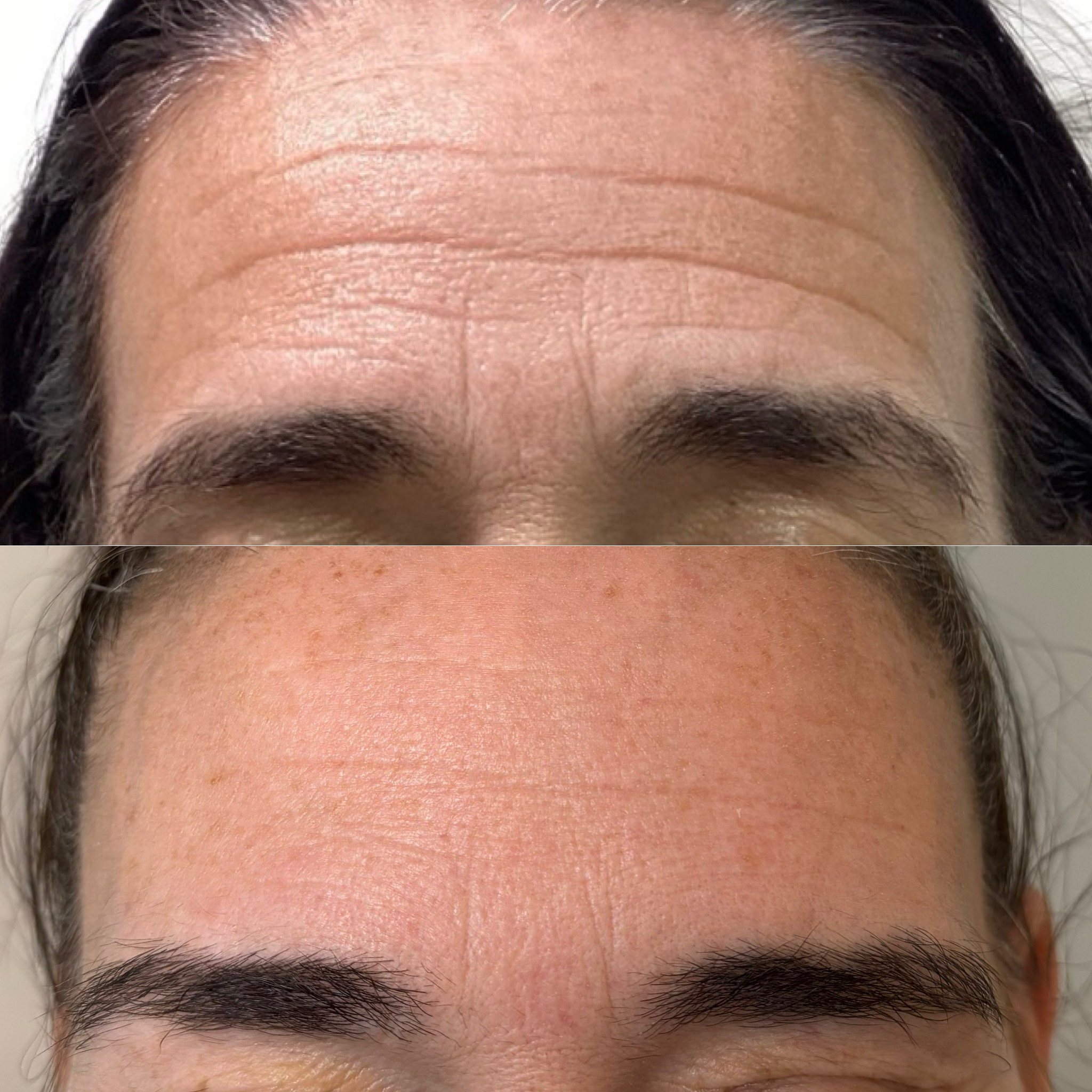 Before and After Image: Dysport (Neurotoxin) - front