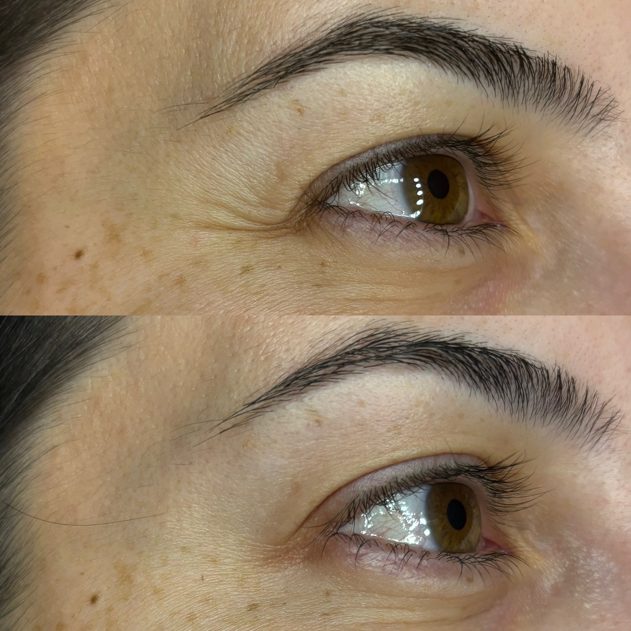 Before and After Image: Dysport (Neurotoxin) - right-front-oblique