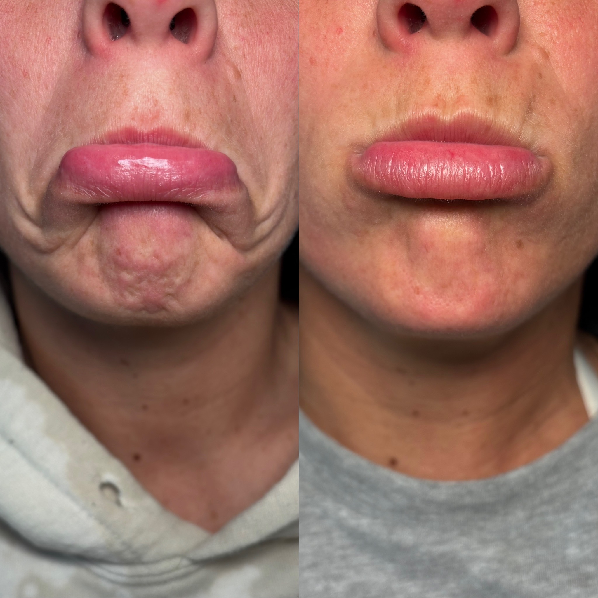 Before and After Image: Dysport (Neurotoxin) - front