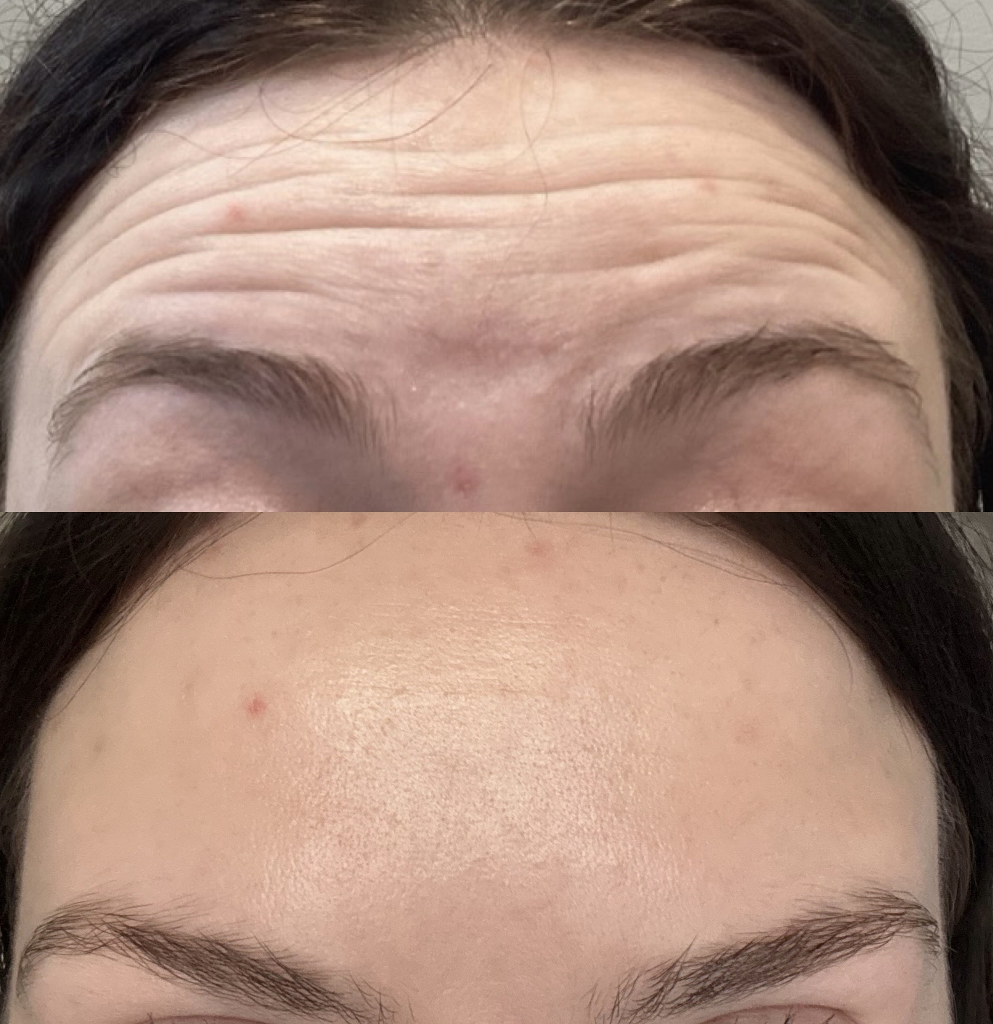 Before and After Image: Dysport (Neurotoxin) - front