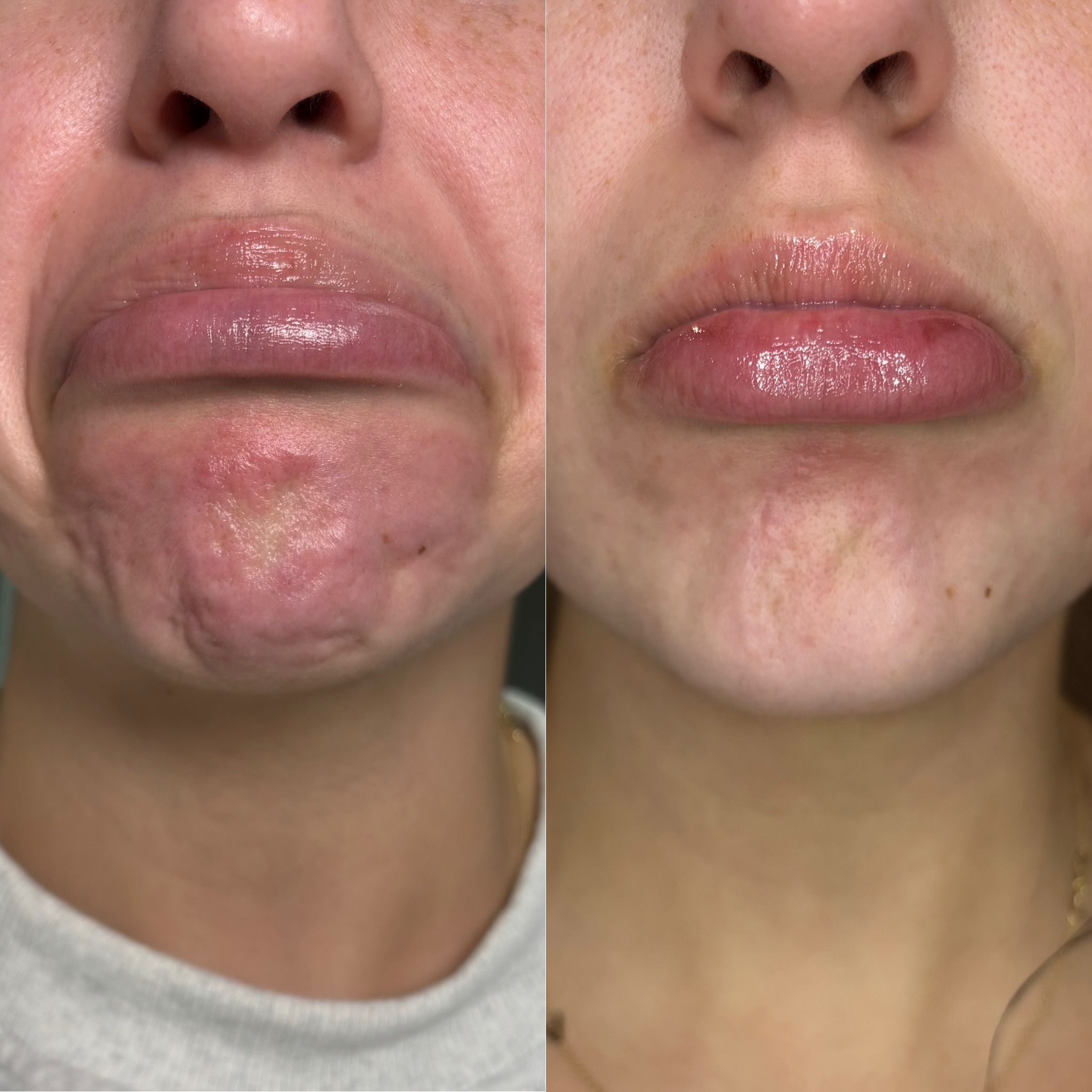 Before and After Image: Dysport (Neurotoxin) - front