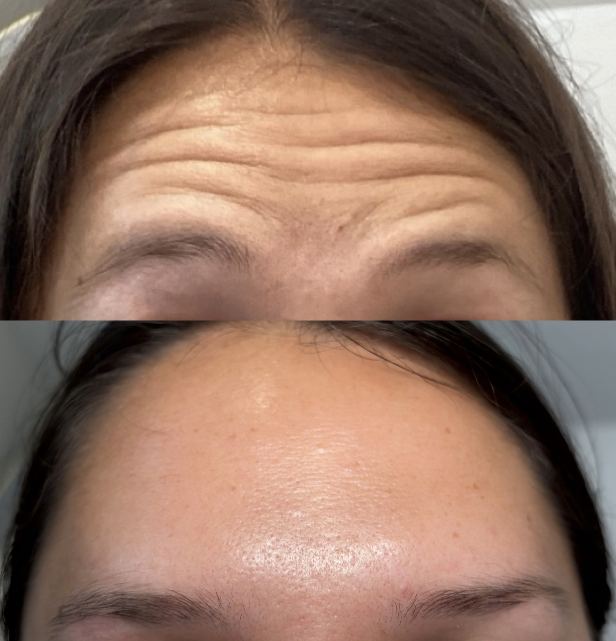 Before and After Image: Dysport (Neurotoxin) - front