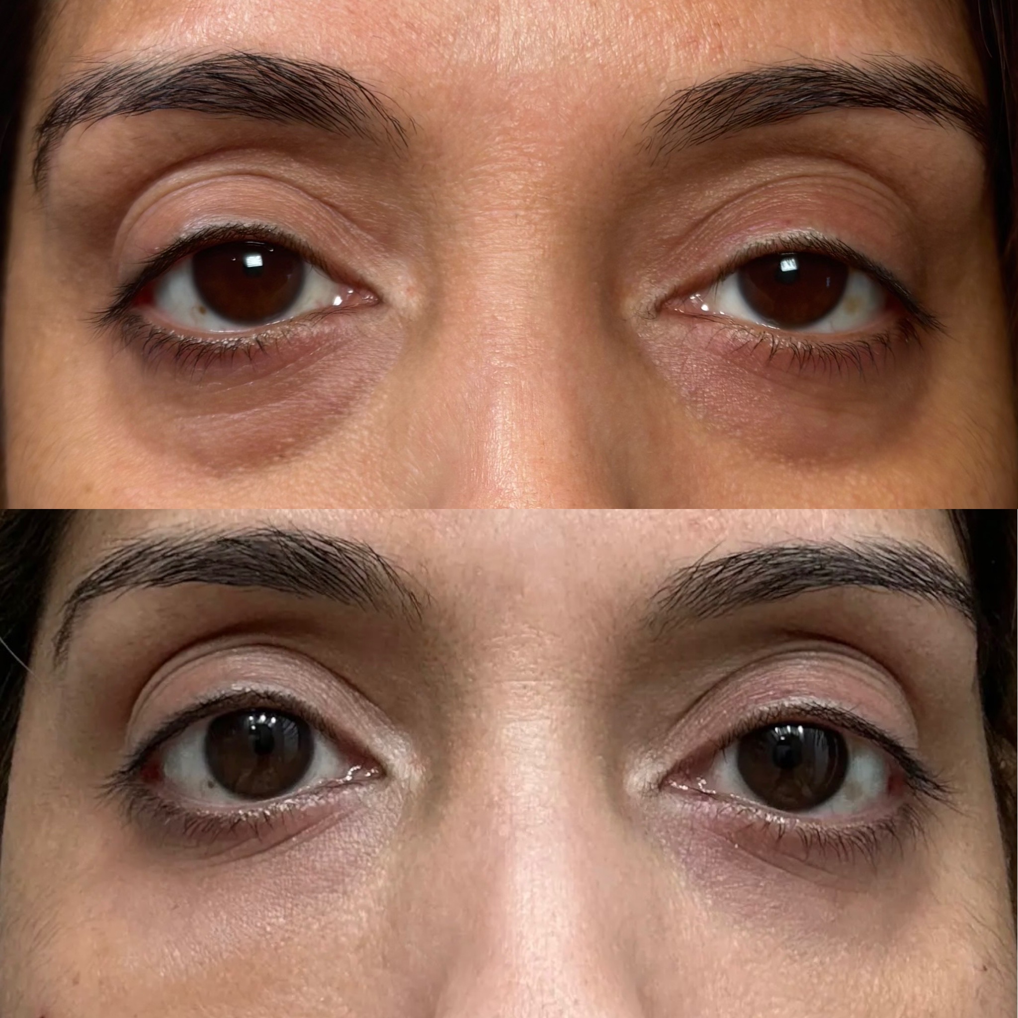 Before and After Image: PRF for Face - front