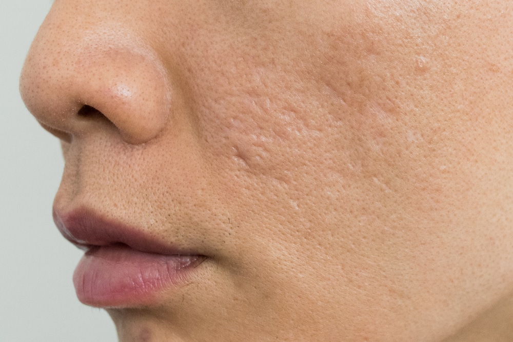 Close-up shot of acne scars Close-up shot of acne scars